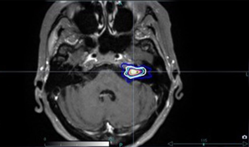 akustikusneurinom fallbeispiel